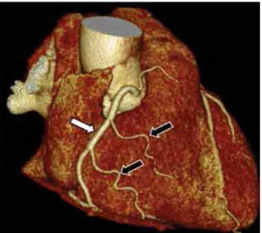 Şekil 6:. Hacimsel BT görüntüsünde kalbin alt kısmındaki kruks kordis düzeyinde RCA’dan köken alan  posteriyor desandan arter (beyaz ok) ve posterolateral dallar (siyah oklar) görülüyor (13)