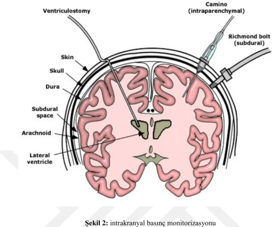 Şekil 2: intrakranyal basınç monitorizasyonu 
