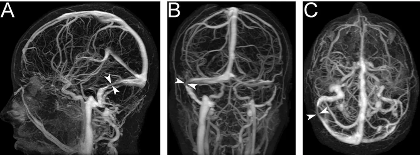 Şekil 8: İİH li bir hastanın MR venografisinde transvers serebral venoz sinüs stenozu görülmektedir