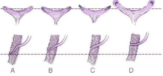 Şekil 4. Üreteral orifislerin normal ve anormal konfigurasyonları. Üst,  endoskopik görünüm