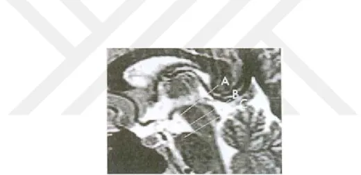 Şekil 2: Orta hat sagittal T2 ağırlıklı görüntüde, serebral akuaduktusun uç anatomik seviyesinde sagittal 