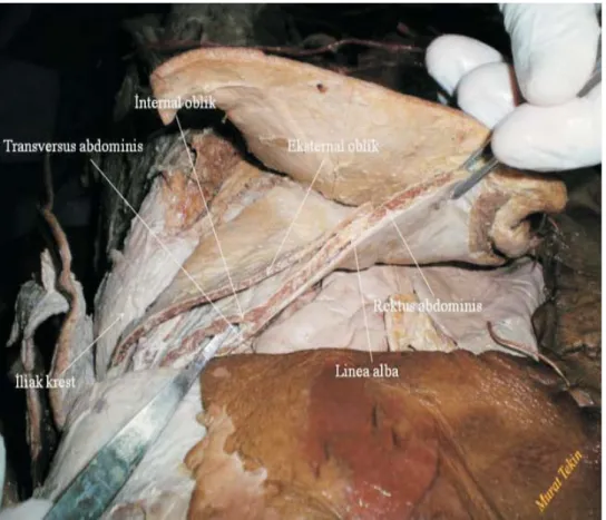 Şekil 1.Karın ön ve yan duvarı kaslarının kadavra görünümü  