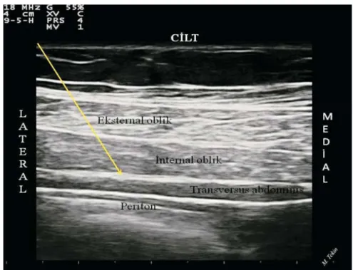 Şekil 4: Karın yan duvarı kaslarının ve transversusabdominis planının ultrasonografik  görünümü 