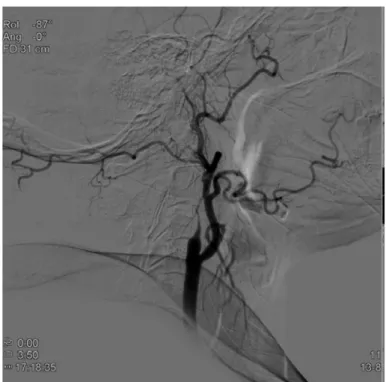 Şekil 4. Karotis diseksiyonunda DSA görüntülemesi.  Karotis DSA’da (lateral görünüm) sağ ICA’nın incelerek tıkandığı görülüyor