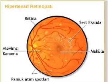 Şekil 1  Hipertansif retinopatideki fundus bulguları  [32]