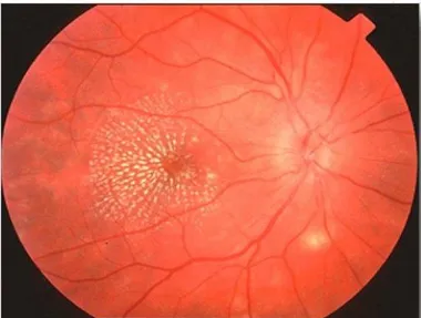 Şekil 2 Hipertansif retinopatide makula yıldızı görünümü  [35]