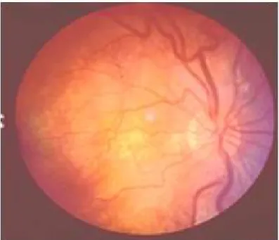 Şekil 3. Grade I hipertansif retinopati  [38] 