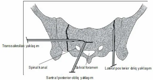 Şekil  8:  Sakral  yetersizlik  kırığına  farklı  yaklaşım  şekilleri,  en  sık  tercih  edilen lateral posterior oblik yaklaşımdır