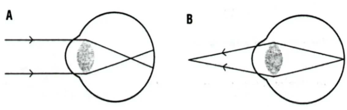 Şekil 2: Miyop gözde uzak nokta düzlemi ve fokus (4) 