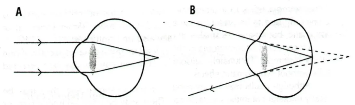 Şekil 3: Hipermetrop gözde uzak nokta düzlemi ve fokus (4) 