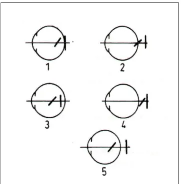 Şekil 5: Çeşitli astigmatizmalarda Sturm Konoidi fokal çizgilerinin retinaya konumları;  1-Basit miyopik, 2-Basit hipermetropik, 3-Kompoze miyopik, 4-Kompoze 