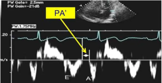 Şekil 2: Doku doppler yöntemi ile AEMG’nin ölçülmesi. PA: EKG’deki P dalgası 