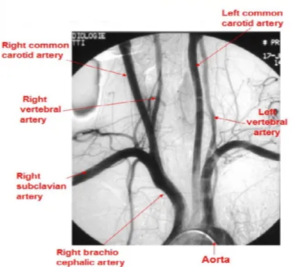 Şekil 1 a: Arcus aorta  ve dallarının anjiografik görüntüsü 