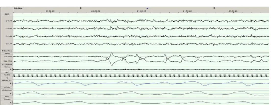 Şekil 6: REM dönemi; Düşük amplitüd, karışık frekanslı EEG, düşük çene EMG, 