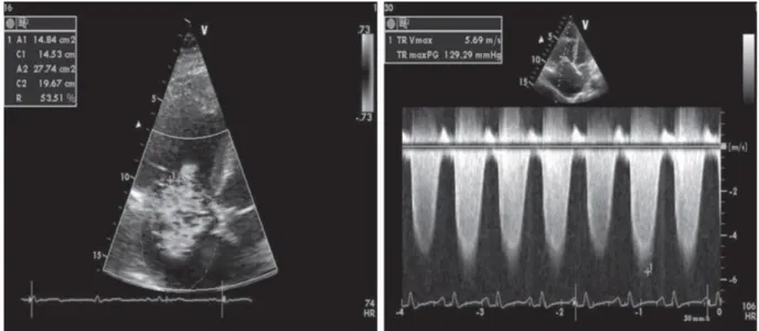 Şekil  2.3.  PAH  hastasında  ağır  derecede  triküspit  yetersizliği  ve  ileri  pulmoner  hipertansiyon  (PAH – pulmoner arteriyel hipertansiyon) 