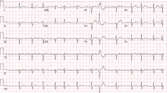 Şekil 2.8. Atriyal Fibriasyon EKG. 