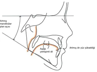 Şekil 6: Büyük adenoidli bir çocukta, dilin  aşağı yerleşiminin, artmış mandibuler plan açısının, artmış ön  yüz yüksekliğinin şematizasyonu
