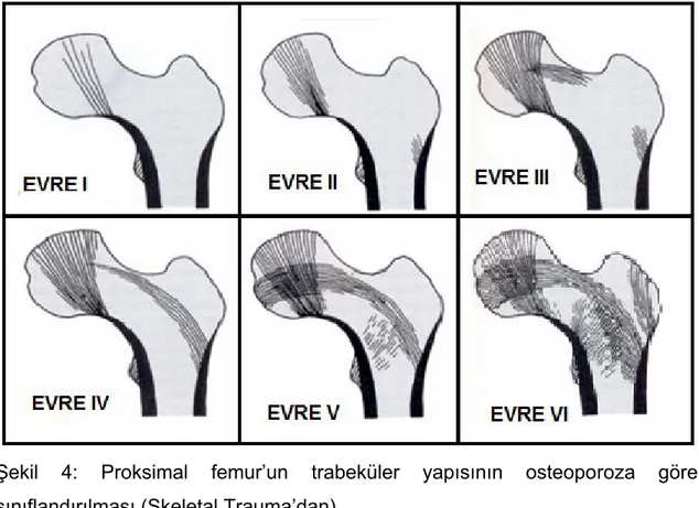Şekil  4:  Proksimal  femur’un  trabeküler  yapısının  osteoporoza  göre  sınıflandırılması (Skeletal Trauma’dan)