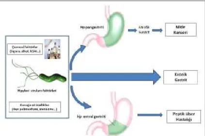 Şekil 3: Helicobacter pylori enfeksiyonunda gastrik patoloji gelişimi ve etkili faktörleri şematik görünümü (53)
