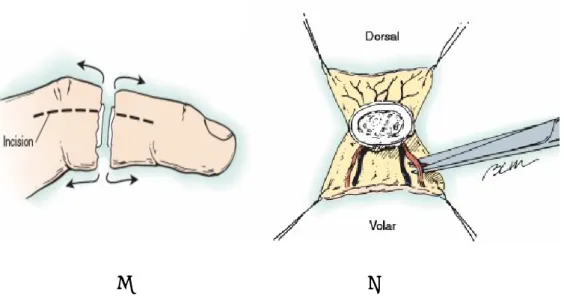 Şekil  -13:  Midlateral  insizyon(A)  ve  nörovasküler  yapıların  eksplorasyonu(B)  (Bone  and