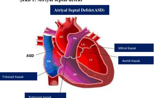 ġekil 1: Atriyal septal defekt 