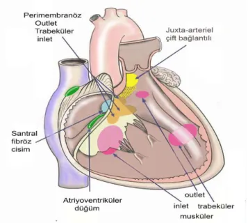 ġekil 2: Anatomik lokalizasyonuna göre VSD tipleri 