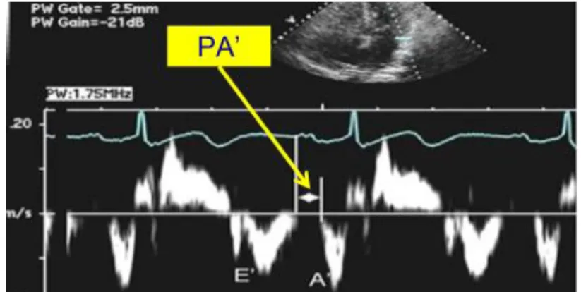 Şekil  1.  Doku  Doppler  yöntemi  ile  AEMG’nin  ölçülmesi.  EKG’deki  P  dalgası  başlangıcından  doku  Doppler  trasesindeki  A  dalgası  baslangıcına  kadar  geçen  süre (PA) AEMG olarak tanımlanır