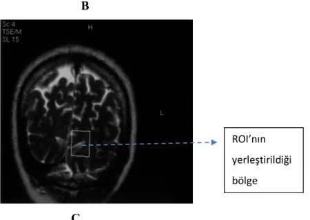 Şekil 4: Görme merkezinin aksiyel (A), sagital (B), koronal (C) görünümü.            3.2