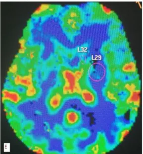 Şekil  4.  NPSLE  (+)  olan  35  yaş  erkek  hastanın  beyin  MRG  de  sağ  paryetalde  (8  nolu  olgu),  A)  T1A 