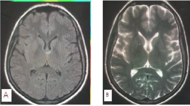 Şekil  5.  NPSLE (+)olan bayan hastanın (1 nolu olgu), A, B) FLAIR ve T2A  görüntülerde sağ İK anterior 