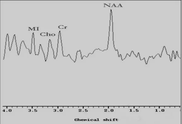 ġekil 5: MRS‟de 3.2 ppm‟de Kolin (Cho) piki, 2.02 ppm‟de N-Asetil Aspartat (NAA) piki, 3.02 ppm‟de 