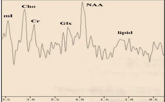 ġekil 7: MRS‟de 2.1- 2.5 ppm‟de görüntülenen Glutamat-Glutamin (Glx) piki 