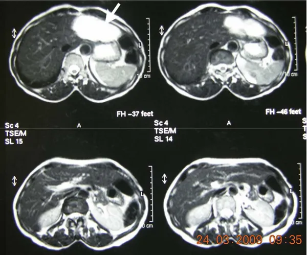 Şekil 5. 60 yaşında bayan hastanın sol lobunu tamamen kaplayan 9x4,5 cm boyutundaki  karaciğer hemanjiyomu kontrastlı MRG’de ok ile gösterilmektedir(OLGU 1)