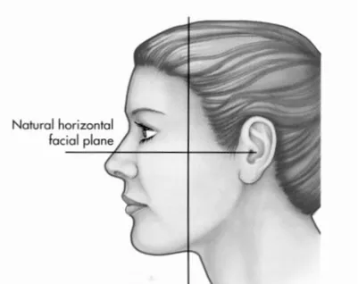 Şekil 13e Natürel horizontal fasial plan düz karşıya bakışta tragustan yere paralel çekilen çizgi ile bunu tam  olarak dik kesen ve şakak hizasından geçen çizgi ile belirlenir (2)