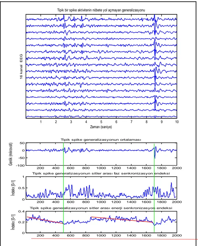Şekil 8. Şekilde kısmen jeneralize olmuş ve hemen hemen tam jeneralize olmuş diken içeren epileptik bir  EEG segmenti gösterilmiştir