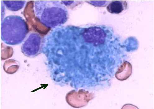 Şekil 10: Pseudo-gaucher hücresi (Lösemik hücrelerden salınan sfingoglikolipid  moleküllerinin depolandığı, parlak sitoplazmik içeriği ve eksantrik nükleusu ile arka  plandaki myeloid hücrelerden kolaylıkla ayırt edilebilen histiyosit)