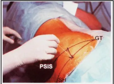 ġekil  1.  Klasik  teknik  ile  siyatik  sinir  bloğu  (PSIS:  spina  iliaka  posterior 