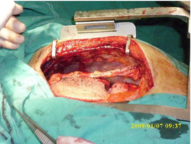 Şekil 1: Sol internal mammarian arterin ekartör koyulduktan sonra çıkarılmış hali