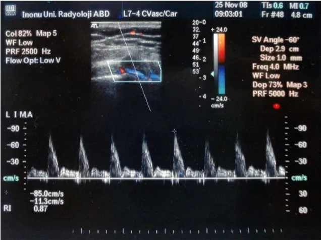 Şekil 5:  Sol internal mammarian arterin spektral Doppler parametreleri