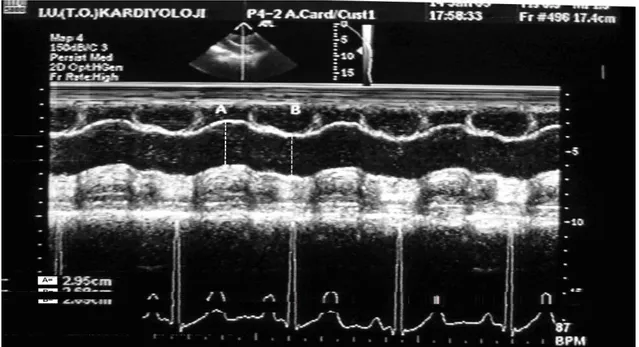 Şekil 3. Aortik sistolik ve diyastolik çapları n ölçülmesi aort kapağ ı n 3 cm üstünde M- M-mode trasesinden alı ndı.