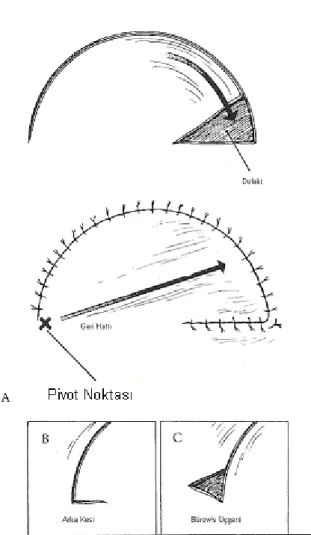 Şekil 1:  Rotasyon Flebi. Place M. J., Herber S. C., and Hardesty R. A. Basic techniques  and  principles  in  plastic  surgery