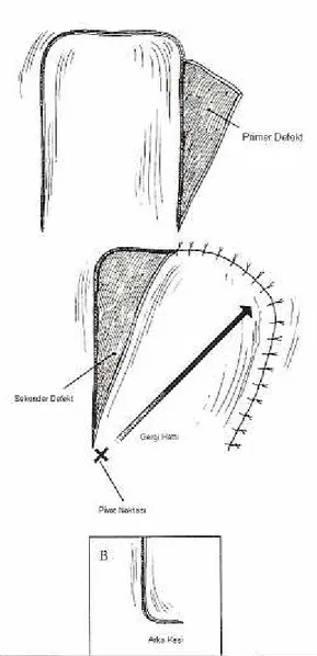 Şekil  2:  Place  M.  J.,  Herber  S.  C.,  and  Hardesty  R.  A.  Basic    techniques  and  principles  in  plastic surgery