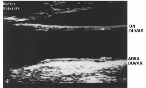 Şekil 1. Ön (yakın) ve arka (uzak) duvarın ultrasonografik görünümü 
