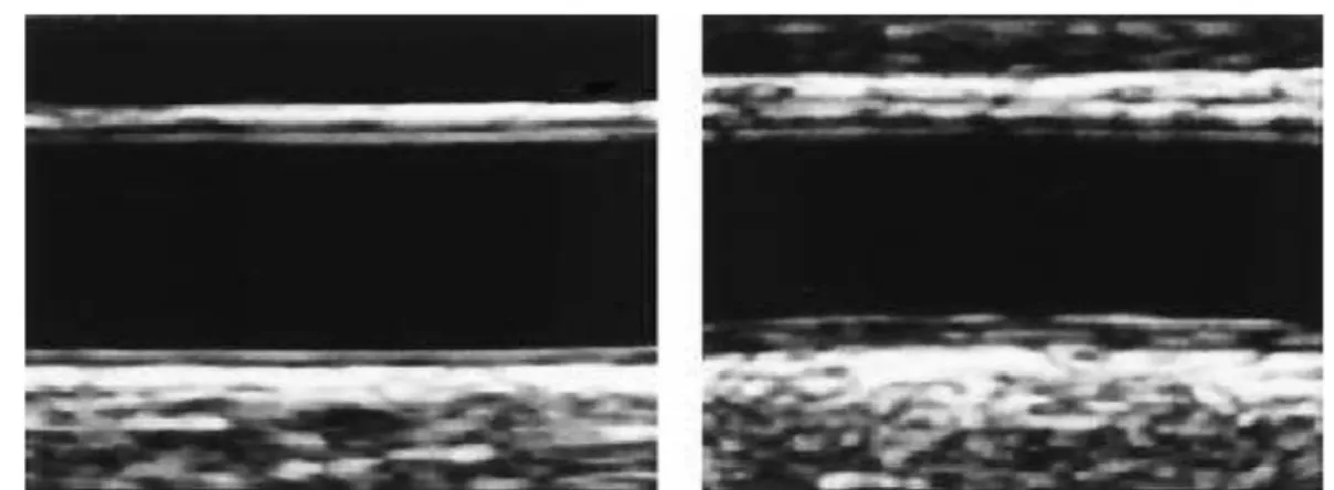 Şekil 5:  İntima-media kalınlığının ultrasonografik görünümü. Solda normal intima- intima-media kalınlığı olan karotis arter; sağda ise intima-intima-media kalınlığı artmış karotis arter