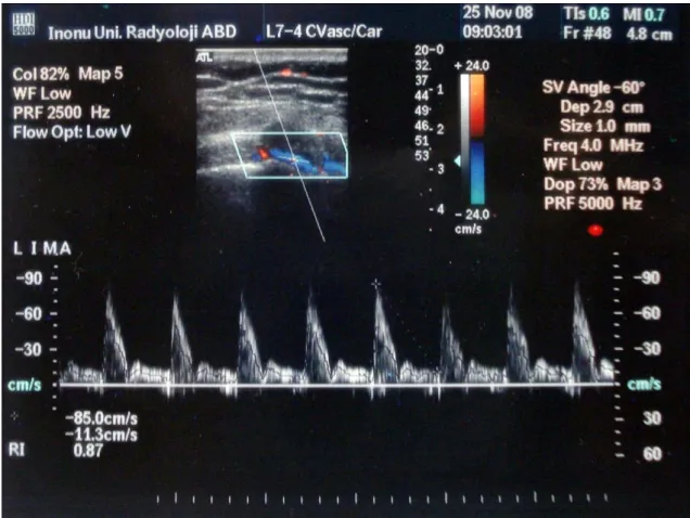 Şekil 9: Sol internal mammarian arterin spektral Doppler parametreleri 