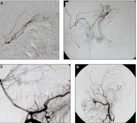 Şekil 2. Orta meningeal arter (A) ve posterior aurikuler arterden (B) kaynaklanan besleyicilerin süperselektif anjiyografileri