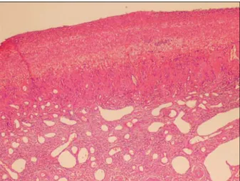 Şekil 1. Fibroid polip endoskopik görünüm Şekil 2. fibroid polip mikroskobik görünüm, yüzeydeülserasyon ve stromada  inflamatuar hücreler ile damarsal yapılar