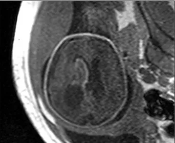 Şekil 1. 32 haftalık fetusta T1-AG aksiyal MR görüntüsünde intraventriküler  hematom ve eşlik eden ventrikülomegali görüntüsü izleniyor.