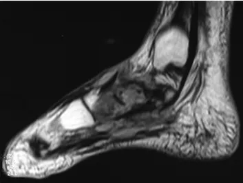 Şekil 4. Ayak MR-FSE yağ baskılamalı T2-ağrılıklı görüntülerde navikular ve  medial küneiform kemiklerde kistik bölgeler ve kemik destrüksiyonu saptandı.