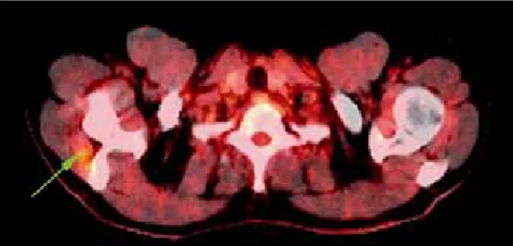 Şekil 1. Sağ infraspinatus kas grubu içerisinde artmış FDG tutulum odağını  gösteren PET/BT füzyon görüntüsü.